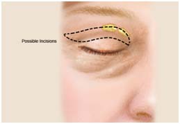 Blepharoplasty Eye Lid Surgery, Blepharoplasty Eye Lid Surgery India, Blepharoplasty Eye Lid Surgery Cost